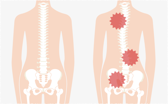 身体が歪んだ状態